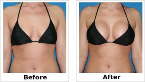 risultati di breast cream