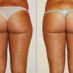 consigli per eliminare i buchi della cellulite