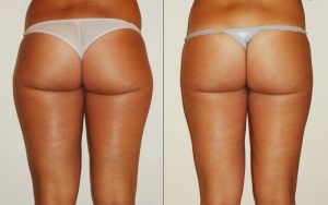 consigli per eliminare i buchi della cellulite