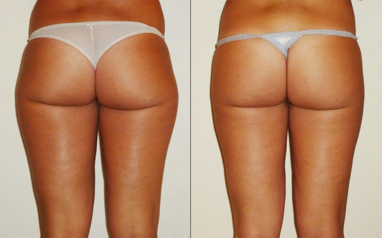 cellulite sui glutei